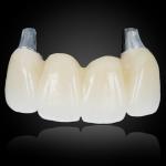 Cemented Implant Crown & Bridge