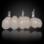 Cemented Implant Crown & Bridge