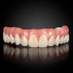 Full Arch Implant