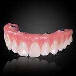 Implant-Retained Hybrid Dentures