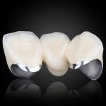 PFM (Base Metal Alloy)