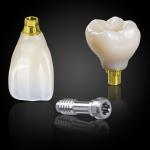 Screw-Retained Implant Crown & Bridge