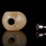 Screw-Retained Implant Crown & Bridge
