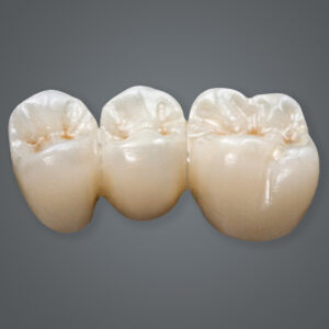 crown-and-bridge-monolithic-zirconia